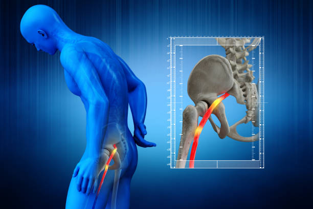 What is the best remedy for sciatica?