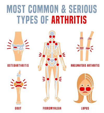 Discover-the-Different-Types-of-Arthritis-and-Find-Relief-in-Just-30-Days