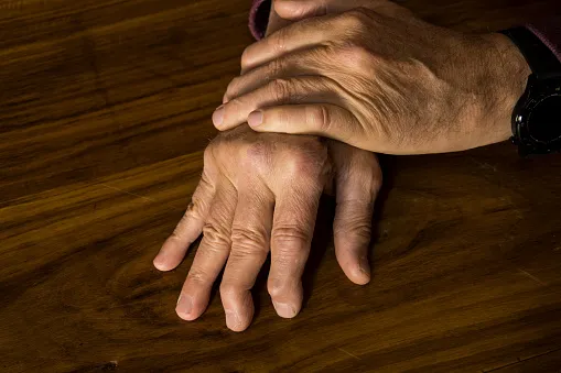 The Complete Guide to Living with Psoriatic Arthritis